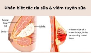 phân biệt viêm tuyến sữa và tắc tia sữa